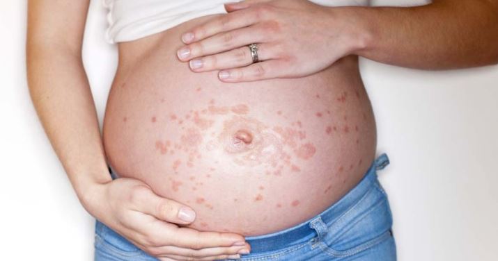 Картинка аллергия у беременных.