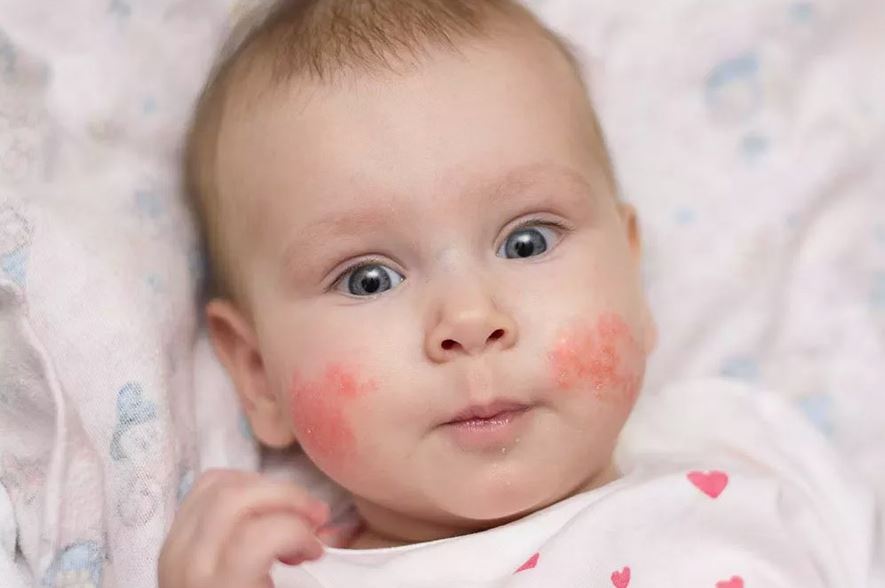 Признаки аллергии у новорожденных