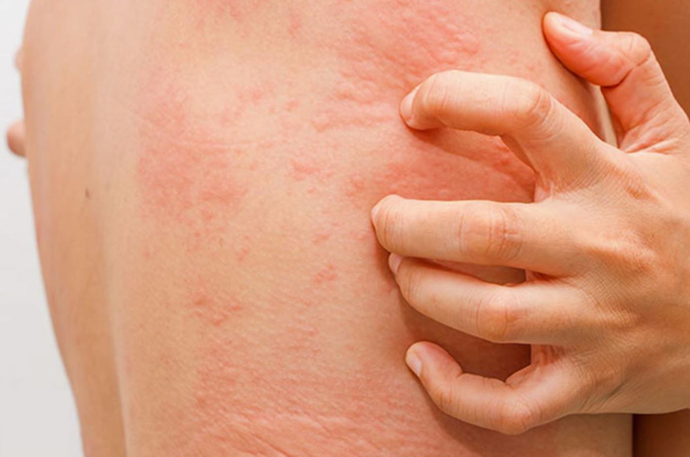 Здоровье: Неаллергические заболевания кожи